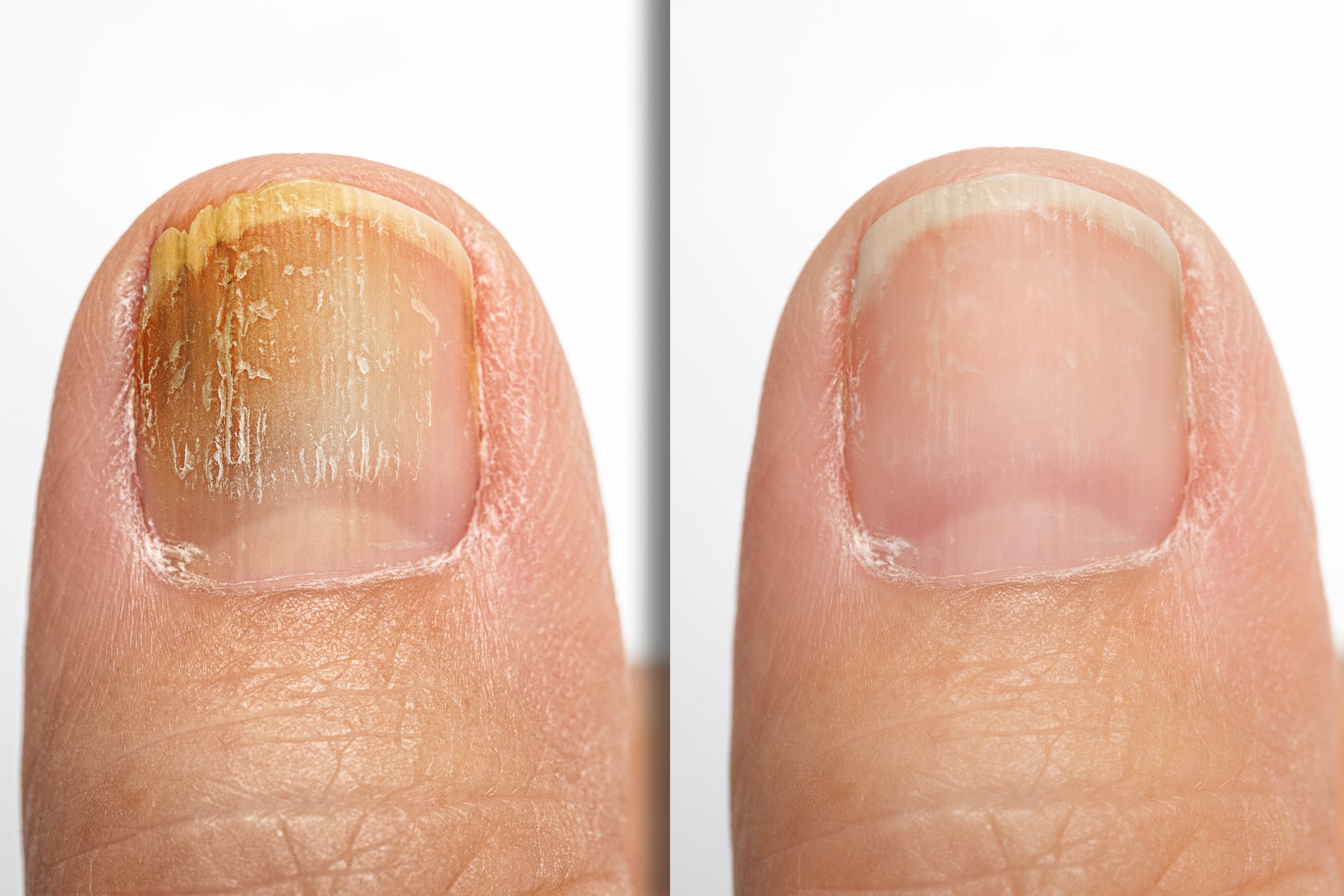 The Role of Antifungal Medication in Treating Toenail Fungus