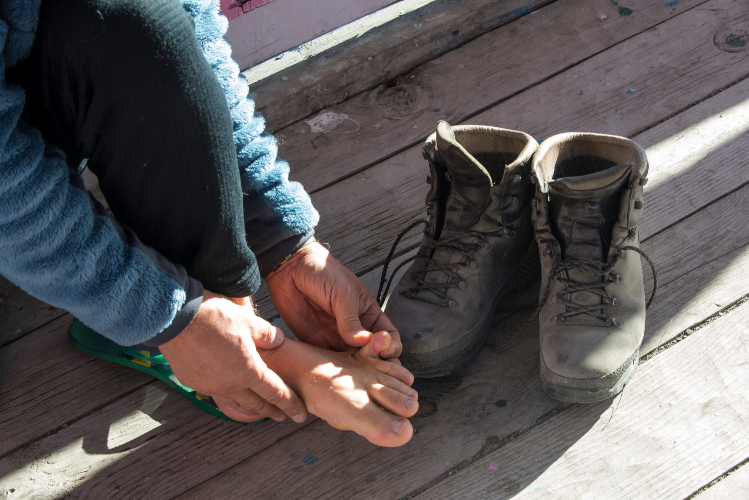 The Impact of Footwear on Toenail Fungus