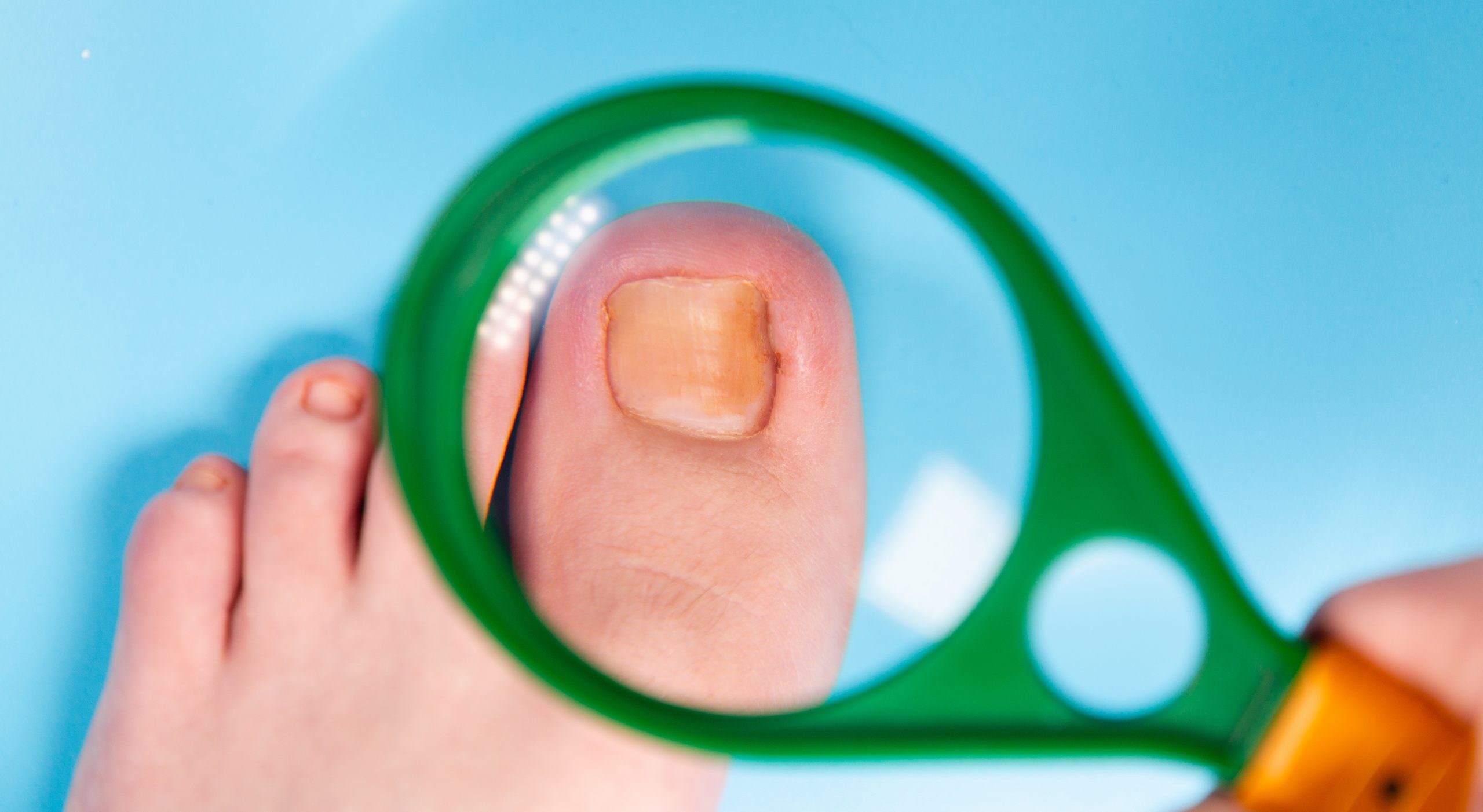 Water intake’s significance in preventing toenail fungus